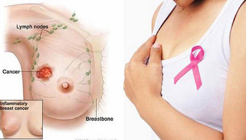 Cách phát hiện ưng thư vú sớm